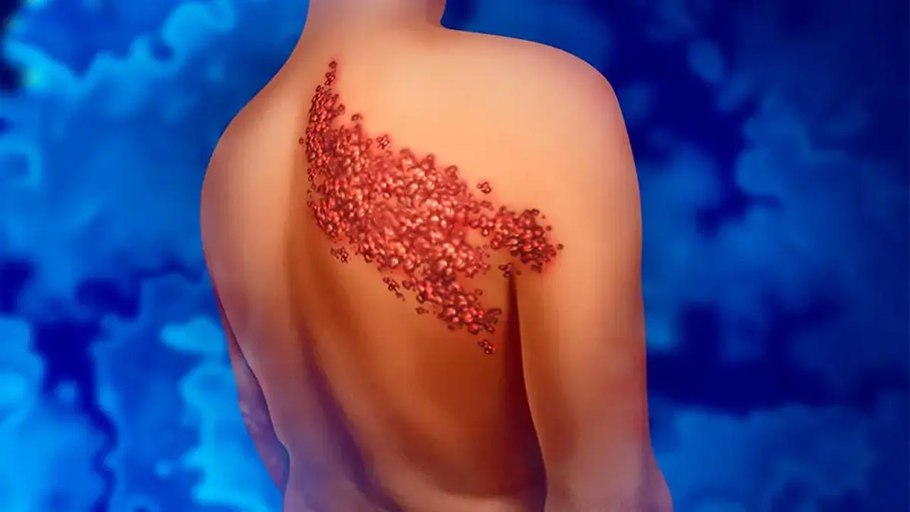 الهربس النطاقي