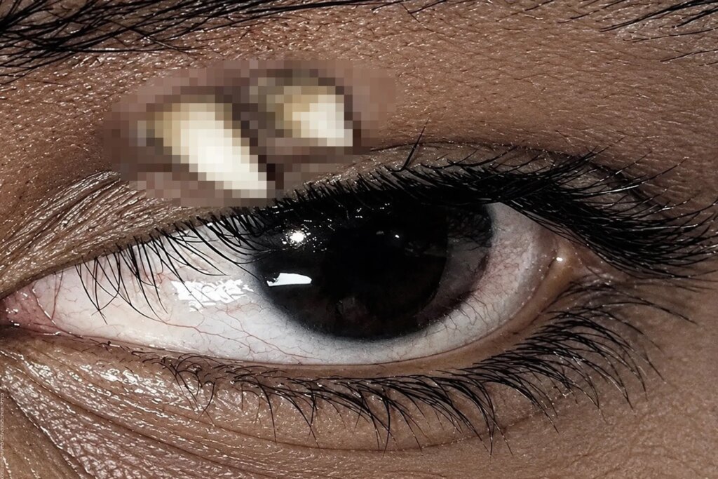 الأسنان المنتبذة